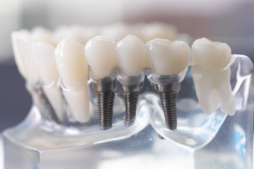 Dental implants - 3Dental Dublin & Limerick